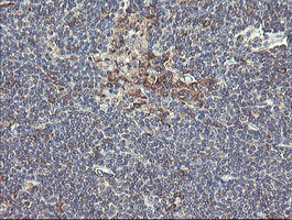 UBE2J1 Antibody - IHC of paraffin-embedded Human lymphoma tissue using anti-UBE2J1 mouse monoclonal antibody.
