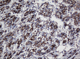 UBE2J1 Antibody - IHC of paraffin-embedded Carcinoma of Human liver tissue using anti-UBE2J1 mouse monoclonal antibody. (Heat-induced epitope retrieval by 10mM citric buffer, pH6.0, 120°C for 3min).