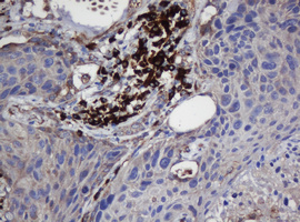 UBE2J1 Antibody - IHC of paraffin-embedded Carcinoma of Human lung tissue using anti-UBE2J1 mouse monoclonal antibody. (Heat-induced epitope retrieval by 10mM citric buffer, pH6.0, 120°C for 3min).