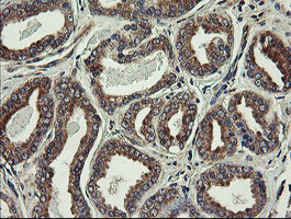 UBE2J1 Antibody - IHC of paraffin-embedded Carcinoma of Human prostate tissue using anti-UBE2J1 mouse monoclonal antibody.