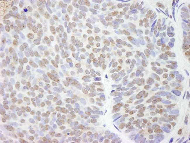 UBE2L3 / UBCH7 Antibody - Detection of Human UBCH7 by Immunohistochemistry. Sample: FFPE section of human basal cell carcinoma. Antibody: Affinity purified rabbit anti-UBCH7 used at a dilution of 1:100.