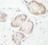 UBE2L3 / UBCH7 Antibody - Detection of Human UBCH7 by Immunohistochemistry. Sample: FFPE section of human prostate carcinoma. Antibody: Affinity purified rabbit anti-UBCH7 used at a dilution of 1:1000 (1 ug/ml). Detection: DAB.