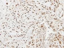 UBE2L3 / UBCH7 Antibody - IHC of paraffin-embedded A549 xenograft using UBE2L3 antibody at 1:100 dilution.