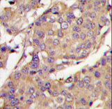 UBE2L6 Antibody - Formalin-fixed and paraffin-embedded breast carcinoma tissue reacted with UBE2L6 Antibody , which was peroxidase-conjugated to the secondary antibody, followed by DAB staining. This data demonstrates the use of this antibody for immunohistochemistry; clinical relevance has not been evaluated.