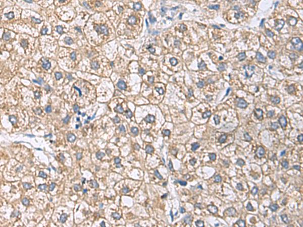 UBE2N / UBC13 Antibody - Immunohistochemistry of paraffin-embedded Human liver cancer tissue  using UBE2N Polyclonal Antibody at dilution of 1:55(×200)