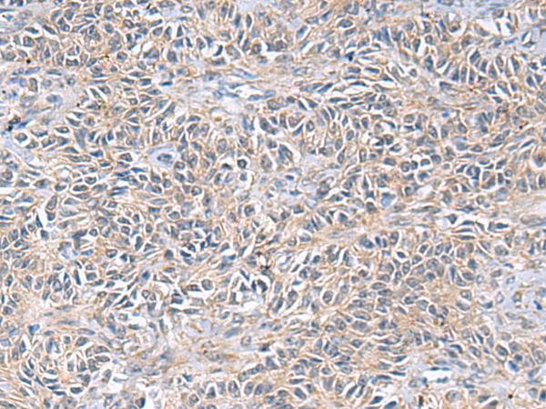 UBE2N / UBC13 Antibody - Immunohistochemistry of paraffin-embedded Human ovarian cancer tissue  using UBE2N Polyclonal Antibody at dilution of 1:55(×200)