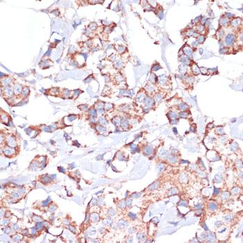 UBE2O Antibody - Immunohistochemistry of paraffin-embedded Human breast cancer using UBE2O Polyclonal Antibody at dilution of 1:100 (40x lens).