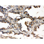 UBE2Q2 Antibody - UBE2Q2 antibody IHC-paraffin. IHC(P): Human Lung Cancer Tissue.