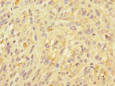 UBE2S / E2 EPF Antibody - Immunohistochemistry of paraffin-embedded human melanoma at dilution 1:100