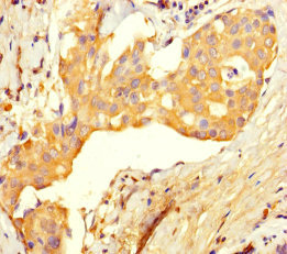 UBE2T / HSPC150 Antibody - Immunohistochemistry of paraffin-embedded human breast cancer using UBE2T Antibody at dilution of 1:100