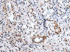 UBE2W Antibody - Immunohistochemistry of paraffin-embedded Human cervical cancer tissue  using UBE2W Polyclonal Antibody at dilution of 1:55(×200)