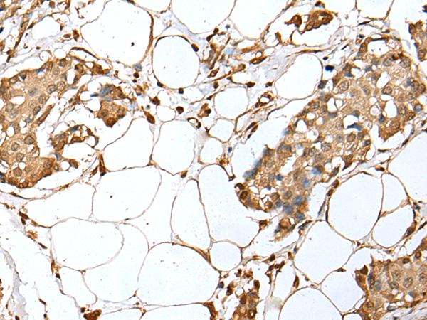 UBE2Z / USE1 Antibody - Immunohistochemistry of paraffin-embedded Human breast cancer tissue  using UBE2Z Polyclonal Antibody at dilution of 1:35(×200)