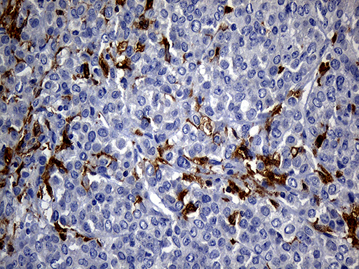 UBE3B Antibody - Immunohistochemical staining of paraffin-embedded Adenocarcinoma of Human breast tissue tissue using anti-UBE3B mouse monoclonal antibody. (Heat-induced epitope retrieval by 1mM EDTA in 10mM Tris buffer. (pH8.5) at 120°C for 3 min. (1:250)