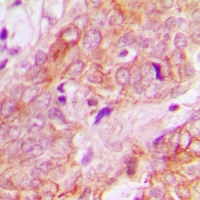 UBE3B Antibody - Immunohistochemical analysis of UBE3B staining in human breast cancer formalin fixed paraffin embedded tissue section. The section was pre-treated using heat mediated antigen retrieval with sodium citrate buffer (pH 6.0). The section was then incubated with the antibody at room temperature and detected with HRP and DAB as chromogen. The section was then counterstained with hematoxylin and mounted with DPX.
