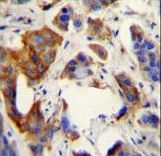 UBFD1 Antibody - UBFD1 antibody immunohistochemistry of formalin-fixed and paraffin-embedded human bladder carcinoma followed by peroxidase-conjugated secondary antibody and DAB staining.