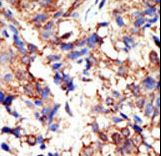 Ubiquilin 2 / UBQLN2 Antibody - Formalin-fixed and paraffin-embedded human cancer tissue reacted with the primary antibody, which was peroxidase-conjugated to the secondary antibody, followed by DAB staining. This data demonstrates the use of this antibody for immunohistochemistry; clinical relevance has not been evaluated. BC = breast carcinoma; HC = hepatocarcinoma.