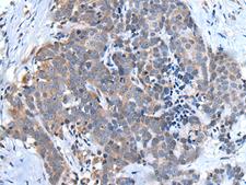Ubiquilin 2 / UBQLN2 Antibody - Immunohistochemistry of paraffin-embedded Human thyroid cancer tissue  using UBQLN2 Polyclonal Antibody at dilution of 1:45(×200)
