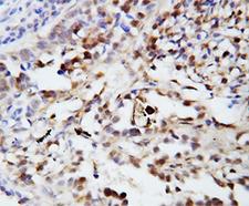 Ubiquitin Antibody - IHC-P: Ubiquitin antibody testing of human lung cancer tissue