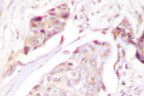 Ubiquitin Antibody - IHC of Ubiquitin (A46) pAb in paraffin-embedded human breast carcinoma tissue.