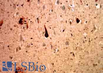 Ubiquitin Antibody - MCA-Ubi-1 staining of cerebral cortex of an Alzheimer patient. Neurofibrillary tangles and dystrophic neurites associated with senile plaques stain strongly with this antibody. In the center is a typical neurofibrillary tangle containing neuron.