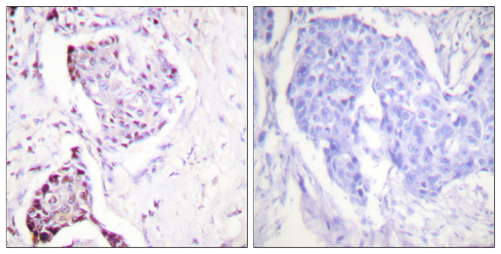 Ubiquitin Antibody - Immunohistochemistry analysis of paraffin-embedded human breast carcinoma tissue, using Ubiquitin Antibody. The picture on the right is blocked with the synthesized peptide.