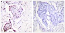 Ubiquitin Antibody - Immunohistochemistry analysis of paraffin-embedded human breast carcinoma tissue, using Ubiquitin Antibody. The picture on the right is blocked with the synthesized peptide.