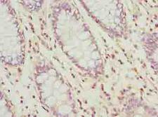 UBL3 Antibody - Immunohistochemistry of paraffin-embedded human colon cancer using antibody at dilution of 1:100.