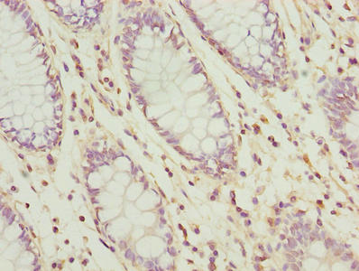 UBL3 Antibody - Immunohistochemistry of paraffin-embedded human colon cancer using UBL3 Antibody at dilution of 1:100