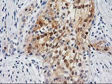 UBL4A Antibody - IHC of paraffin-embedded Carcinoma of Human pancreas tissue using anti-UBL4A mouse monoclonal antibody.