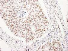 UBL7 Antibody - Detection of Human UBL7 by Immunohistochemistry. Sample: FFPE section of human lung carcinoma. Antibody: Affinity purified rabbit anti-UBL7 used at a dilution of 1:1000 (1 ug/ml). Detection: DAB.