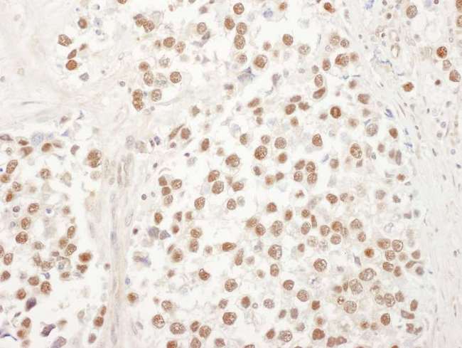 UBL7 Antibody - Detection of Human UBL7 by Immunohistochemistry. Sample: FFPE section of human testicular seminoma. Antibody: Affinity purified rabbit anti-UBL7 used at a dilution of 1:1000 (1 ug/ml). Detection: DAB.