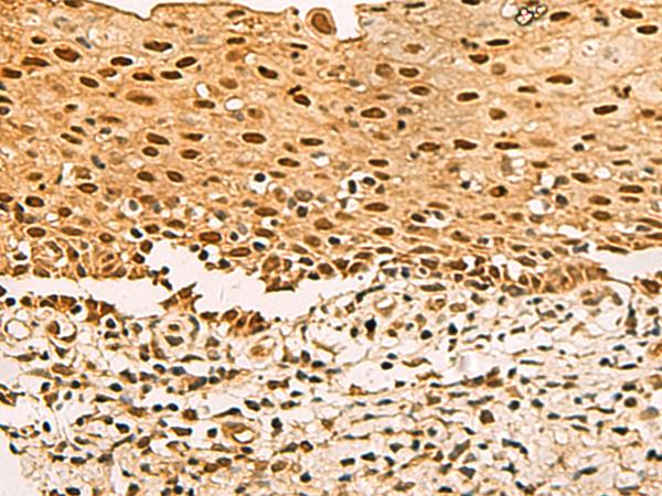 UBLCP1 Antibody - Immunohistochemistry of paraffin-embedded Human cervical cancer tissue  using UBLCP1 Polyclonal Antibody at dilution of 1:80(×200)