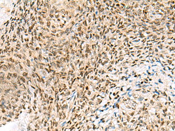UBLCP1 Antibody - Immunohistochemistry of paraffin-embedded Human cervical cancer tissue  using UBLCP1 Polyclonal Antibody at dilution of 1:85(×200)