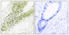 UBN1 / Ubinuclein 1 Antibody - Peptide - + Immunohistochemistry analysis of paraffin-embedded human colon carcinoma tissue, using Ubinuclein antibody.