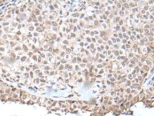 UBN1 / Ubinuclein 1 Antibody - Immunohistochemistry of paraffin-embedded Human ovarian cancer tissue  using UBN1 Polyclonal Antibody at dilution of 1:130(×200)