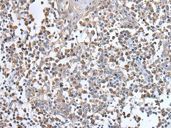 UBN1 / Ubinuclein 1 Antibody - Immunohistochemistry of paraffin-embedded Human tonsil tissue  using UBN1 Polyclonal Antibody at dilution of 1:130(×200)