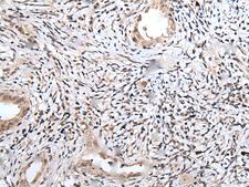 UBN1 / Ubinuclein 1 Antibody - Immunohistochemistry of paraffin-embedded Human cervical cancer tissue  using UBN1 Polyclonal Antibody at dilution of 1:75(×200)