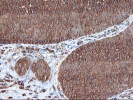 UBOX5 Antibody - IHC of paraffin-embedded Carcinoma of Human bladder tissue using anti-UBOX5 mouse monoclonal antibody. (Heat-induced epitope retrieval by 10mM citric buffer, pH6.0, 100C for 10min).