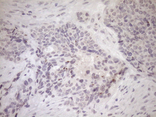 UBP1 Antibody - Immunohistochemical staining of paraffin-embedded Adenocarcinoma of Human endometrium tissue using anti-UBP1 mouse monoclonal antibody. (Heat-induced epitope retrieval by 1mM EDTA in 10mM Tris buffer. (pH8.5) at 120°C for 3 min. (1:150)