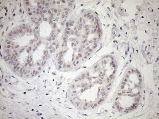 UBP1 Antibody - Immunohistochemical staining of paraffin-embedded Adenocarcinoma of Human breast tissue using anti-UBP1 mouse monoclonal antibody. (Heat-induced epitope retrieval by 1mM EDTA in 10mM Tris buffer. (pH8.5) at 120°C for 3 min. (1:150)