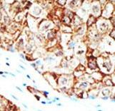 UBQLN1 / Ubiquilin Antibody - Formalin-fixed and paraffin-embedded human cancer tissue reacted with the primary antibody, which was peroxidase-conjugated to the secondary antibody, followed by AEC staining. This data demonstrates the use of this antibody for immunohistochemistry; clinical relevance has not been evaluated. BC = breast carcinoma; HC = hepatocarcinoma.