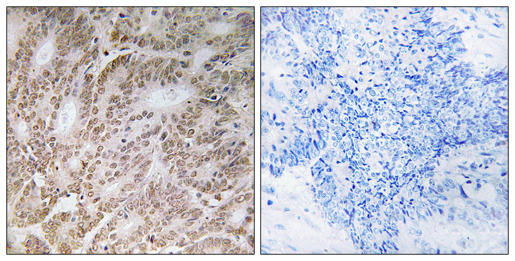 UBQLN4 Antibody - Immunohistochemistry analysis of paraffin-embedded human colon carcinoma tissue, using UBQLN4 Antibody. The picture on the right is blocked with the synthesized peptide.