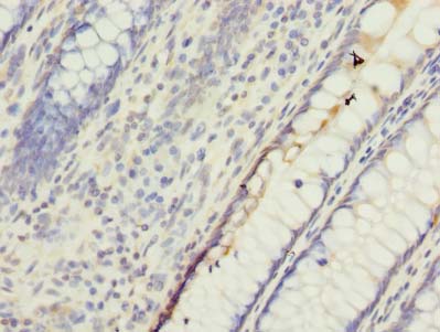 UBQLNL Antibody - Immunohistochemistry of paraffin-embedded human colon cancer using antibody at dilution of 1:100.