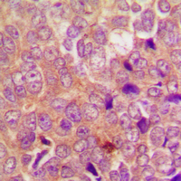 UBR1 Antibody - Immunohistochemical analysis of UBR1 staining in human breast cancer formalin fixed paraffin embedded tissue section. The section was pre-treated using heat mediated antigen retrieval with sodium citrate buffer (pH 6.0). The section was then incubated with the antibody at room temperature and detected using an HRP conjugated compact polymer system. DAB was used as the chromogen. The section was then counterstained with hematoxylin and mounted with DPX.