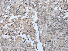 UBR2 Antibody - Immunohistochemistry of paraffin-embedded Human lung cancer tissue  using UBR2 Polyclonal Antibody at dilution of 1:55(×200)
