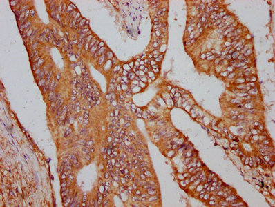 UBR3 Antibody - Immunohistochemistry Dilution at 1:600 and staining in paraffin-embedded human colon cancer performed on a Leica BondTM system. After dewaxing and hydration, antigen retrieval was mediated by high pressure in a citrate buffer (pH 6.0). Section was blocked with 10% normal Goat serum 30min at RT. Then primary antibody (1% BSA) was incubated at 4°C overnight. The primary is detected by a biotinylated Secondary antibody and visualized using an HRP conjugated SP system.