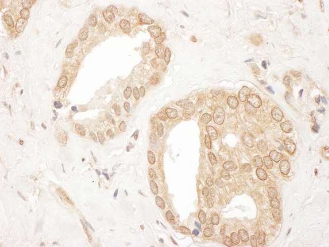 UBR4 Antibody - Detection of Human p600 by Immunohistochemistry. Sample: FFPE section of human prostate carcinoma. Antibody: Affinity purified rabbit anti-p600 used at a dilution of 1:1000 (1 ug/ml). Detection: DAB.