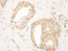 UBR4 Antibody - Detection of Human p600 by Immunohistochemistry. Sample: FFPE section of human prostate carcinoma. Antibody: Affinity purified rabbit anti-p600 used at a dilution of 1:1000 (1 ug/ml). Detection: DAB.