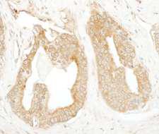 UBR4 Antibody - Detection of Human p600 by Immunohistochemistry. Sample: FFPE section of human prostate carcinoma. Antibody: Affinity purified rabbit anti-p600 used at a dilution of 1:250.