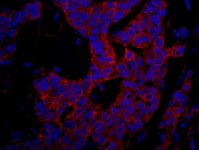 UBR4 Antibody - Detection of Human p600 by Immunohistochemistry. Sample: FFPE section of human prostate carcinoma. Antibody: Affinity purified rabbit anti-p600 used at a dilution of 1:100. Detection: Red-fluorescent Goat anti-Rabbit IgG-heavy and light chain cross-adsorbed Antibody DyLight 594 Conjugated (A120-601D4) used at a dilution of 1:100.